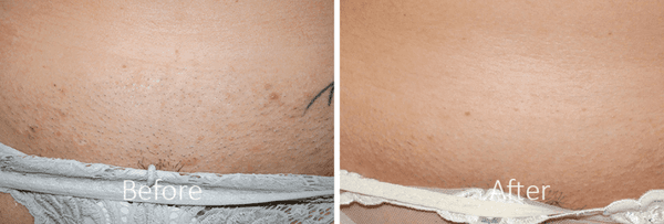 Laser Hair Removal before and after pics. Laser Hair Removal, Pain Free Laser Hair Removal