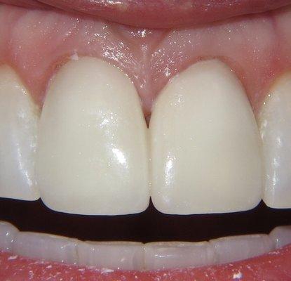 These didn't look like real teeth at all. Cosmetic dentistry at this practice turned into a living nightmare.yellowish ugly veneers. Ruined