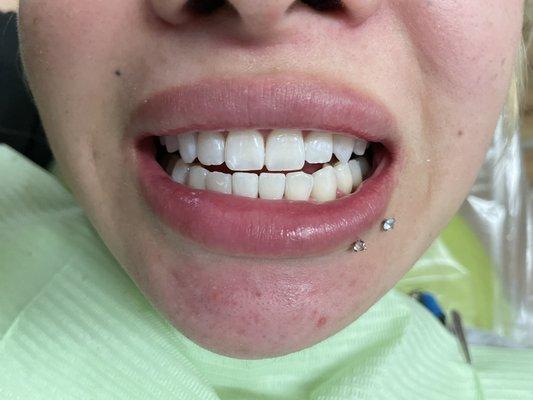 Happy patients with the new colour of her teeth after Zoom whitening