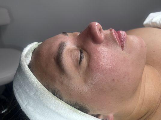 Lymphatic total Facial