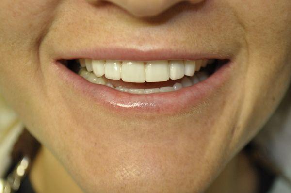 Actual patient.  Porcelain Cosmetic Veneers.  Wow !!!