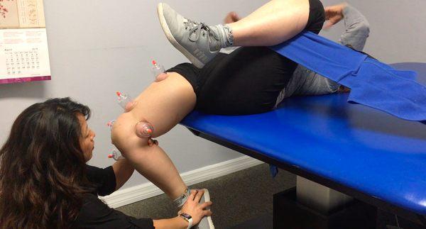 Cupping with mobilization/stretch to hip/knee