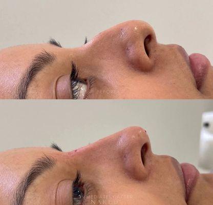 Non Surgical Nose Before & Immediately After