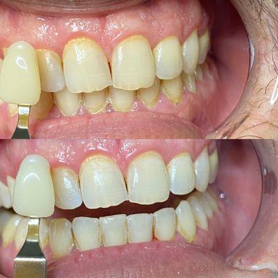 Witness the magic of our teeth whitening session! Just one visit for these stunning results. Ready for your bright smile?