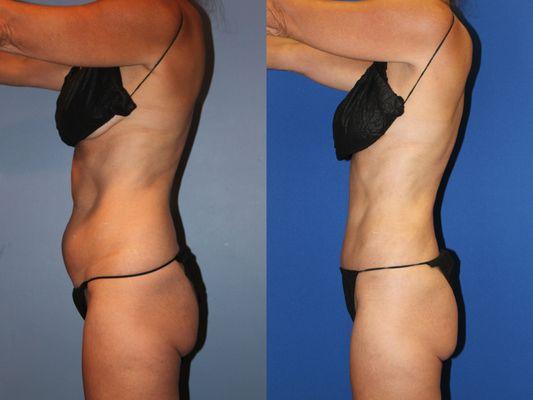 VASER Liposuction of the abdomen, waist and hips.