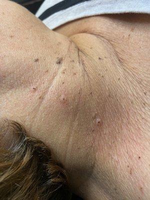 Skin tag removal (after)