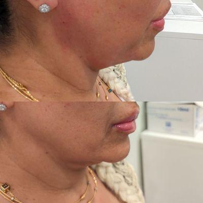 Lower Face - Thread Lift A nonsurgical procedure that lifts sagging, aging skin and stimulates collagen production.