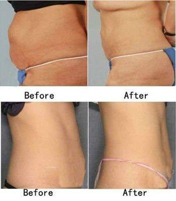 Before & After Cavi-Lipo