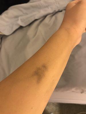 Bruised arm