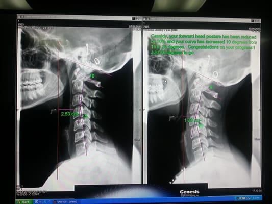 My spinal x-rays and progress so far!