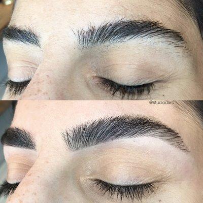 Brow rehab