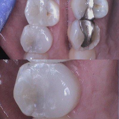 White composite material to replace and restore old amalgam fillings.