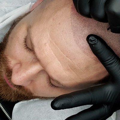 NJ Scalp Micropigmentation