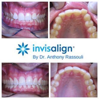 Another beautiful smile transformation with Invisalign!