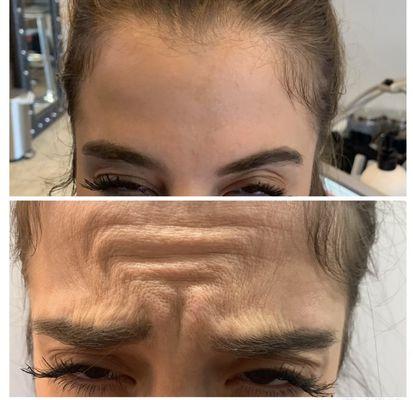 Before and 2 weeks post Botox treatment