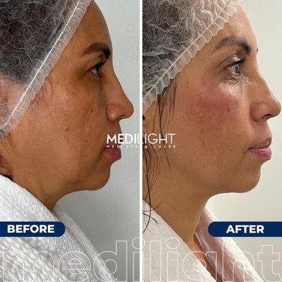 Before & After TriLift face lift