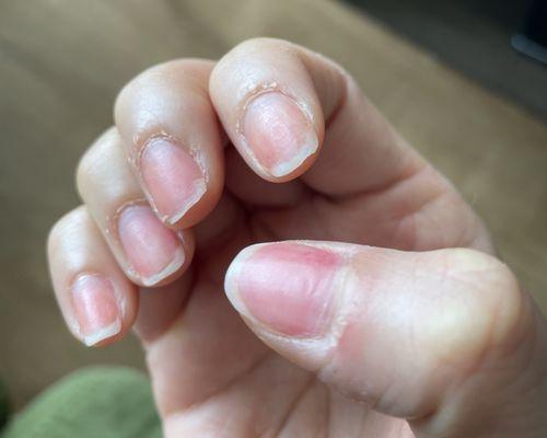 Fragile and brittle nails with dents/unevenness on thumb and pointer