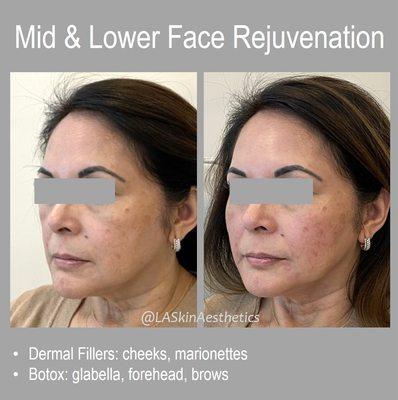 Total facial rejuvenation: neuromodulators and dermal fillers were used on the entire face