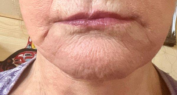 After: marionette lines, scars and irregular lip line