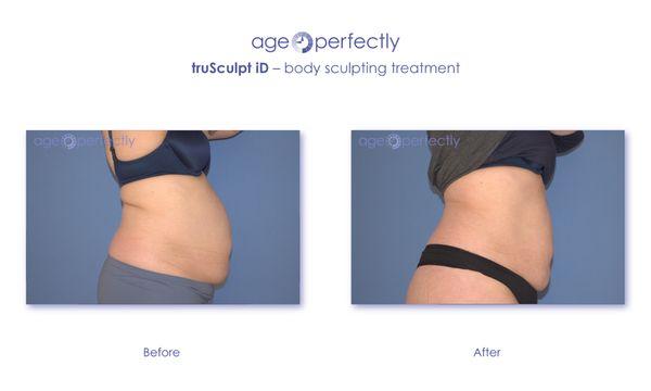 Body Sculpting/fat reduction. truSculpt ID at age-perfectly.com