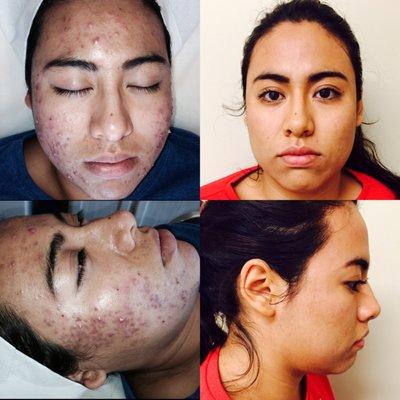 Before and after Acne treatment ( 2 months)