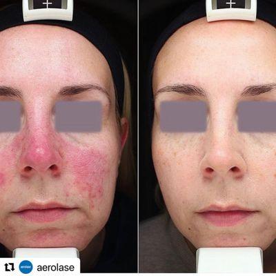 Improvement of Rosacea with Aerolase laser.