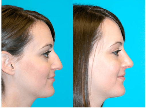 Rhinoplasty (Nose Job) Before and After by Dr. Hecht in Phoenix.