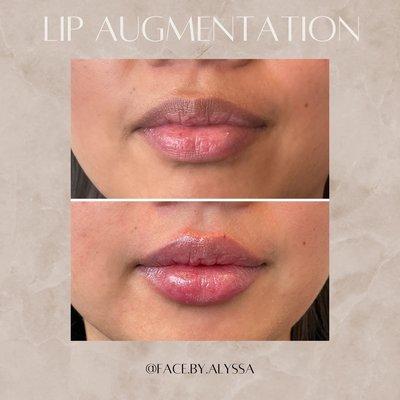 Lip augmentation by Nurse Alyssa