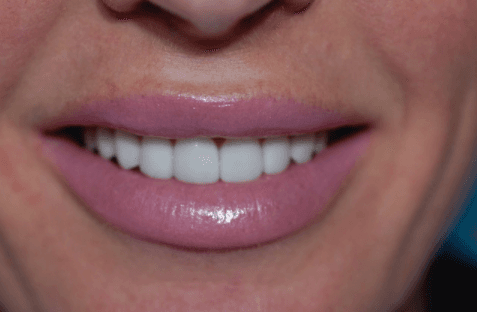 After First Choice Dental veneers