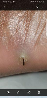 Can you believe this big splinter was missed by a doctor who cut this same area and said she remove it?