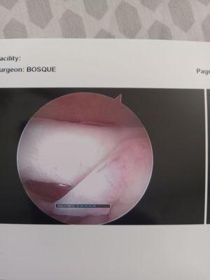 Inside my shoulder after surgery.