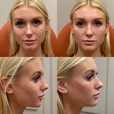 Full facial rejuvenation with dermal fillers.