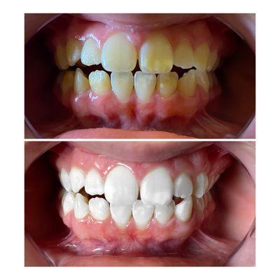 Teeth whitening - 60 minute session