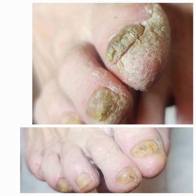 We rountinely address thick nails and callus, this is one of our specialities!