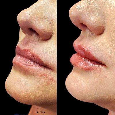 Before and after Lip filler