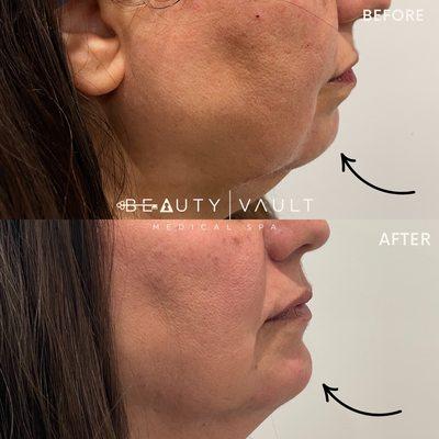 Chin Filler Before & After Beauty Vault Med Spa in West Hollywood, CA