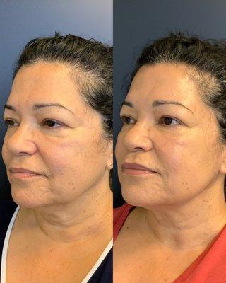 PDO Thread Lift, Lip Filler, and Botox for instant facelift