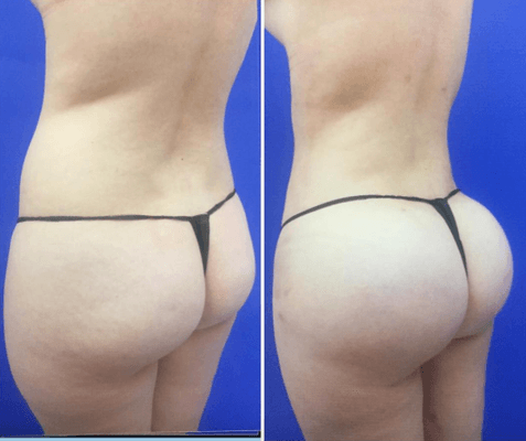 BBL (Brazilian Butt Lift)