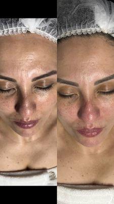 before and after Brightening Facial by Andrea