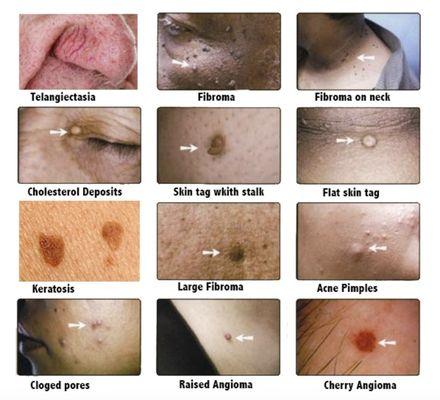 Remove these and other common minor skin imperfections quickly and effectively.