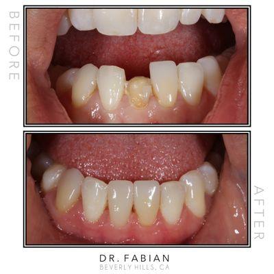 This patient came in after cracking a veneer. We were able to use our CEREC machine to mirror the tooth next to it and fix her smile.