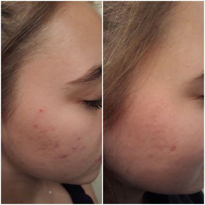 This was only 5 weeks on Lilac and Flint Acne Home care Regimen. We have tried 4 other lines and nothing has worked like this.