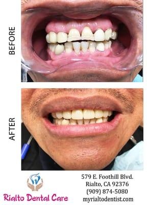 Case of the Month: A transformed smile for a patient who wanted all upper anterior crowns. After 3 visits, he couldn't stop smiling!