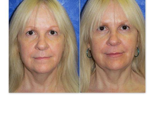 Liquid facelift with Juvederm and Botox