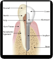 Dental Implant