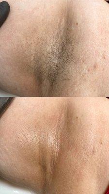 Underarm B&A