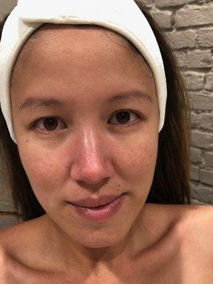 "Before" European Facial