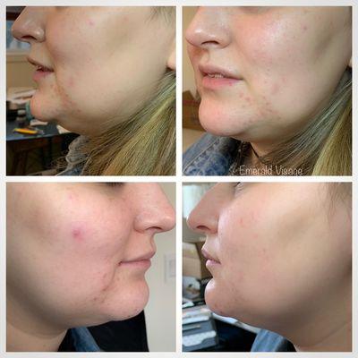 Kybella treatment before/after round 1.