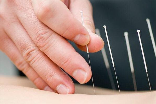 Acupuncture with very thin needles