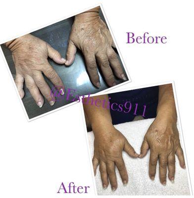 Improvement after 1 treatment. Anti-aging Treatment